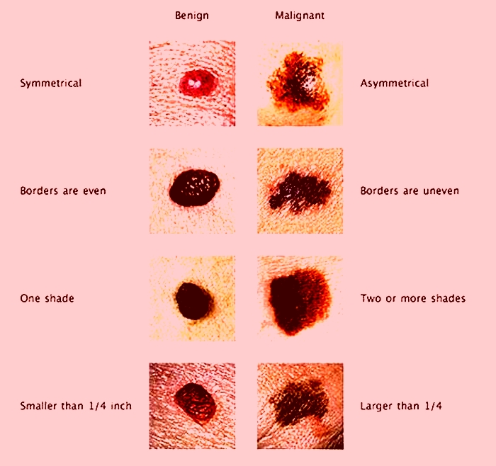 Are black warts cancerous