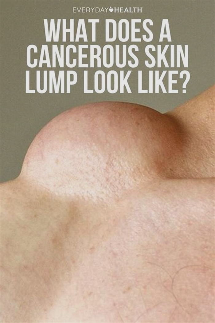 Are cancerous lumps hard or soft?