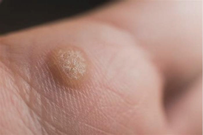 How can I tell if a wart is cancerous?