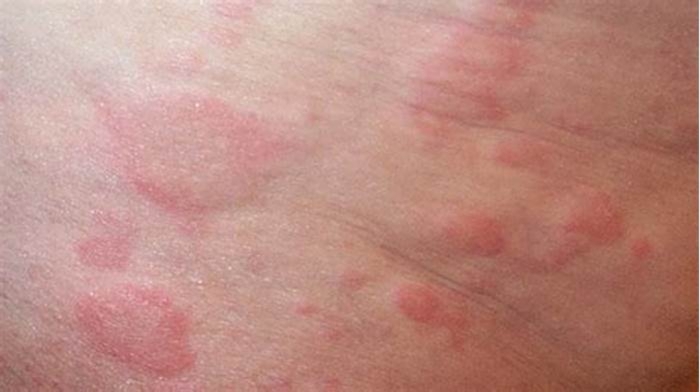 What does a pet allergy rash look like?