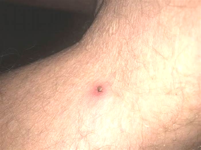 What does a tick bump look like?